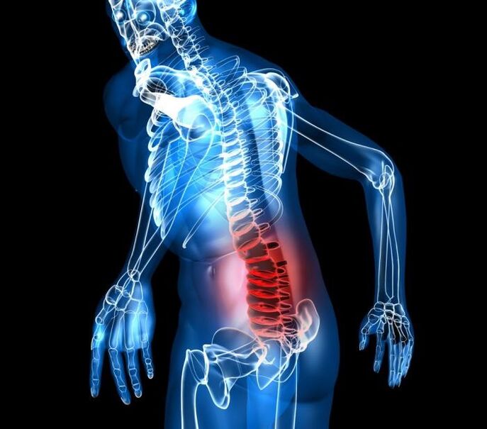 jostas osteohondrozes pakāpes un attīstības posmi