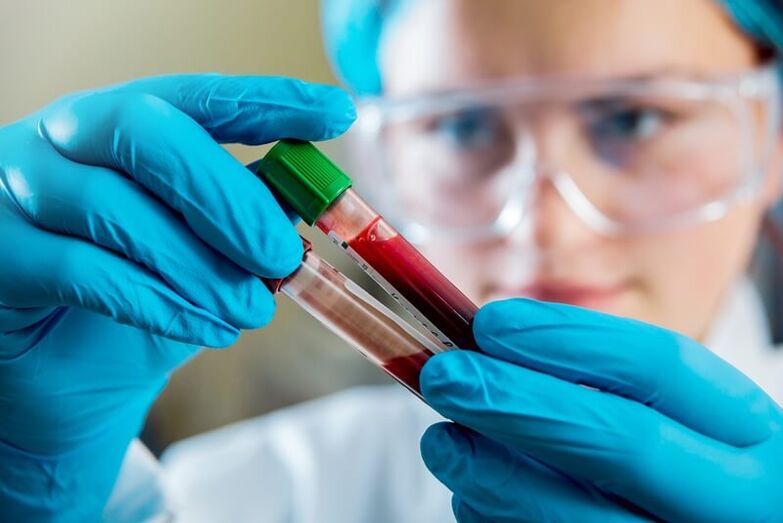 Pilnīga asins analīze, lai diagnosticētu muguras sāpes