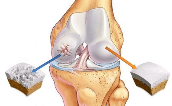 Ceļa locītavas (pa kreisi) un parastā skrimšļa (labā) osteoartrīts