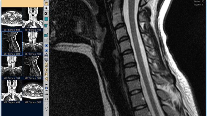 Dzemdes kakla mugurkaula MRI ir labākā metode kakla sāpju diagnosticēšanai